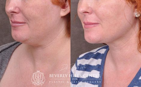 Beverly Hills Center Female Patient Before and After Mini Weekend Necklift Procedure