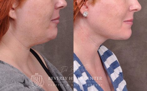 Beverly Hills Center Female Patient Before and After Mini Weekend Necklift Procedure