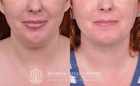 Beverly Hills Center Female Patient Before and After Mini Weekend Necklift Procedure