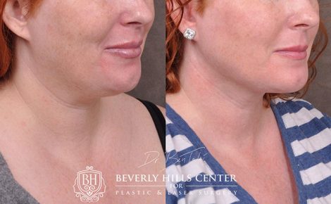 Beverly Hills Center Female Patient Before and After Mini Weekend Necklift Procedure