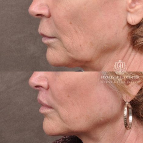 Beverly Hills Center Female Patient Before and After Lip Lift