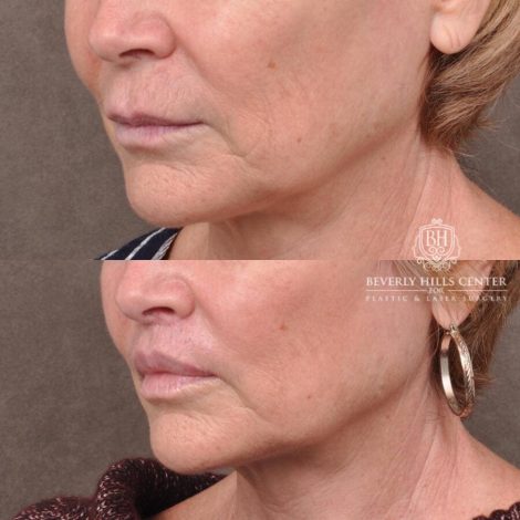 Beverly Hills Center Female Patient Before and After Lip Lift
