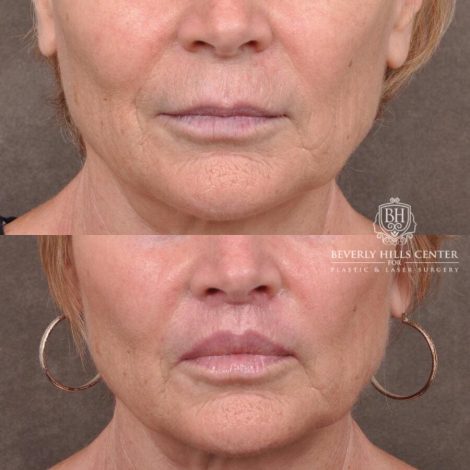 Beverly Hills Center Female Patient Before and After Lip Lift
