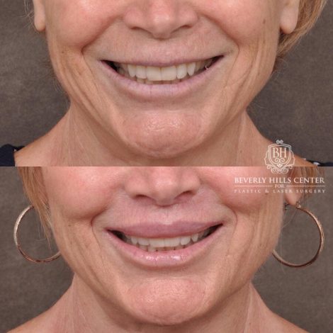 Beverly Hills Center Female Patient Before and After Lip Lift