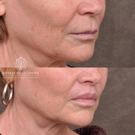 Beverly Hills Center Female Patient Before and After Lip Lift