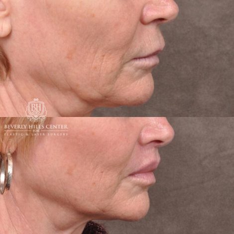 Beverly Hills Center Female Patient Before and After Lip Lift
