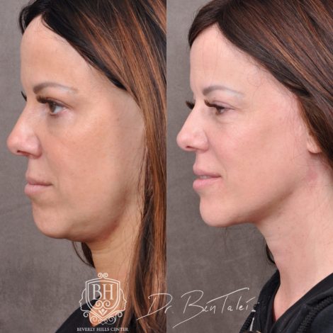 Beverly Hills Center Female Patient Before and After Profound Rf