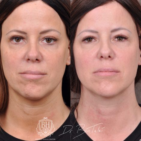 Beverly Hills Center Female Patient Before and After Profound Rf