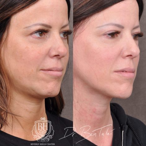 Beverly Hills Center Female Patient Before and After Profound Rf