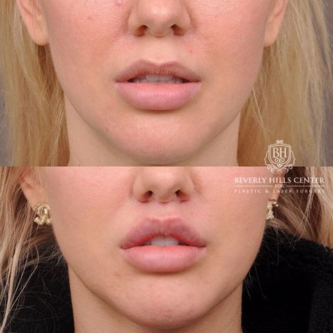 Before and after photo Upper Lip Lift-Procedure: Upper Lip Lift
