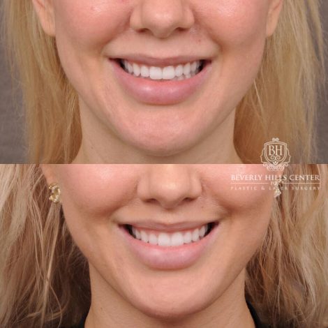 Before and after photo Upper Lip Lift-Procedure: Upper Lip Lift
