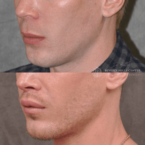 Beverly Hills Center Male Patient Before and After Modified Upper Lip Lift Procedure