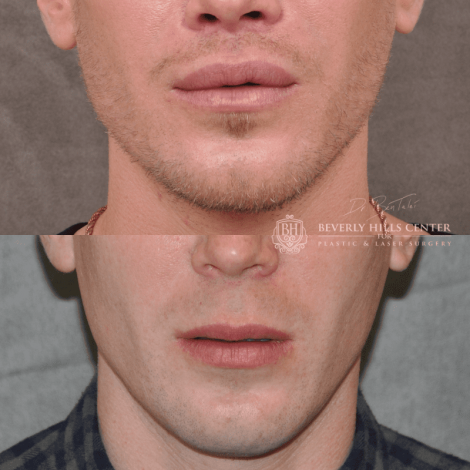 Beverly Hills Center Male Patient Before and After Modified Upper Lip Lift Procedure
