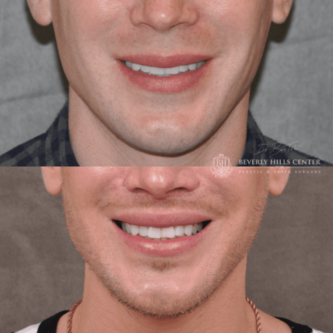 Beverly Hills Center Male Patient Before and After Modified Upper Lip Lift Procedure