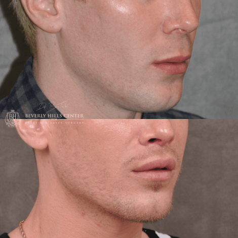 Beverly Hills Center Male Patient Before and After Modified Upper Lip Lift Procedure