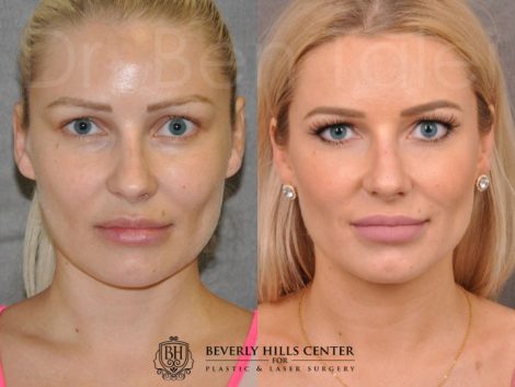 Beverly Hills Center Female Patient Before and After Profound RadioFrequecy Procedure