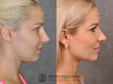 Beverly Hills Center Female Patient Before and After Profound RadioFrequecy Procedure