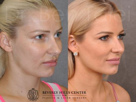 Beverly Hills Center Female Patient Before and After Profound RadioFrequecy Procedure