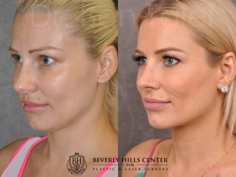 Beverly Hills Center Female Patient Before and After Profound RadioFrequecy Procedure