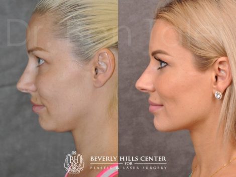 Beverly Hills Center Female Patient Before and After Profound RadioFrequecy Procedure