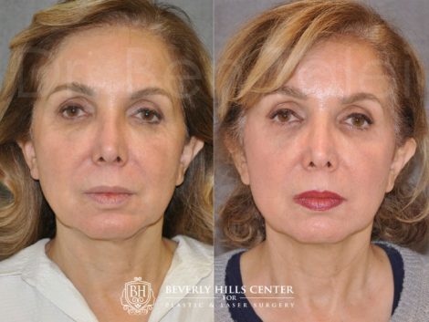 Beverly Hills Center Female Patient Before and After Profound Skin Tightening Procedure