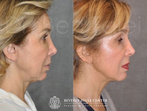 Beverly Hills Center Female Patient Before and After Profound Skin Tightening Procedure