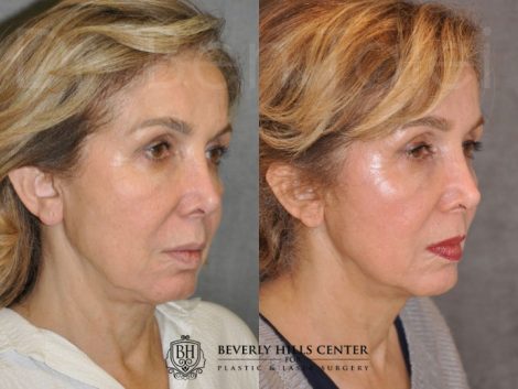 Beverly Hills Center Female Patient Before and After Profound Skin Tightening Procedure