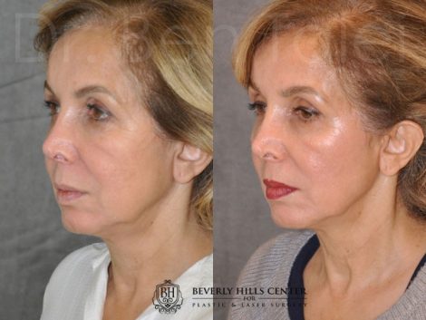 Beverly Hills Center Female Patient Before and After Profound Skin Tightening Procedure