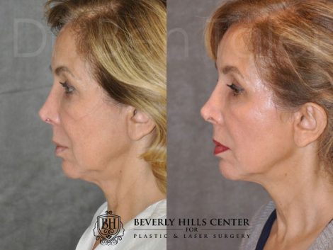 Beverly Hills Center Female Patient Before and After Profound Skin Tightening Procedure