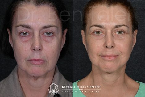 Beverly Hills Center Female Patient Before and After Fractionated CO2 Laser Skin Resurfacing Procedure