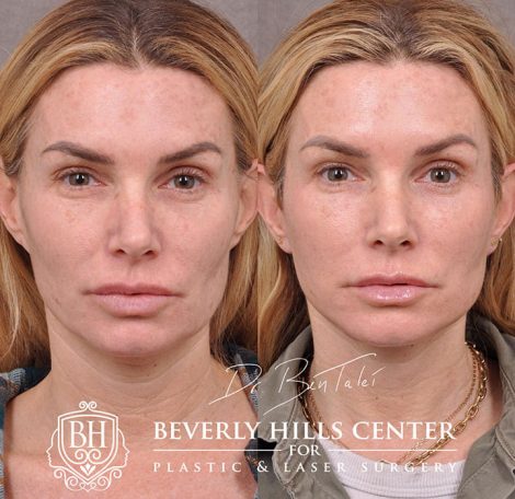 Beverly Hills Center Female Patient Before and After AuraLyft Procedure