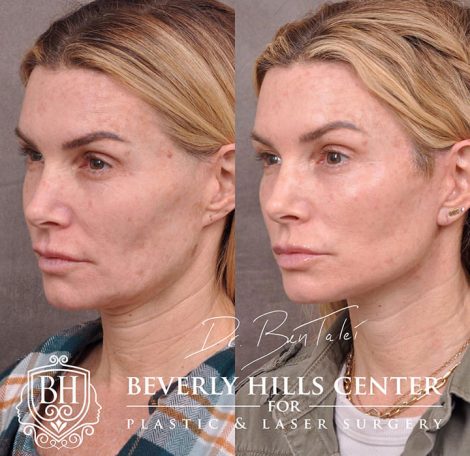 Beverly Hills Center Female Patient Before and After AuraLyft Procedure