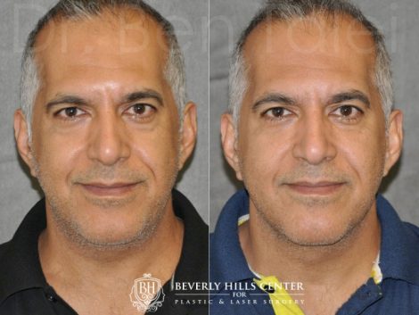 Beverly Hills Center Male Patient Before and After Profound MicroLift Procedure