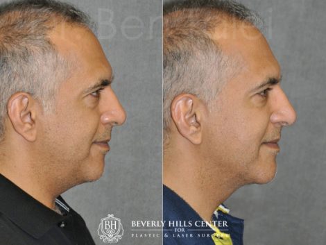 Beverly Hills Center Male Patient Before and After Profound MicroLift Procedure