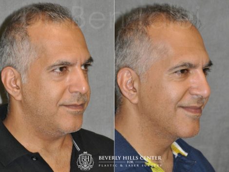 Beverly Hills Center Male Patient Before and After Profound MicroLift Procedure
