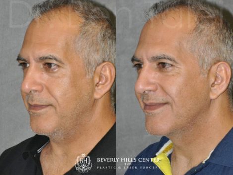 Beverly Hills Center Male Patient Before and After Profound MicroLift Procedure