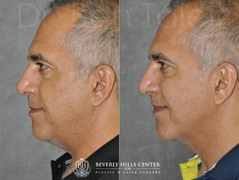 Beverly Hills Center Male Patient Before and After Profound MicroLift Procedure