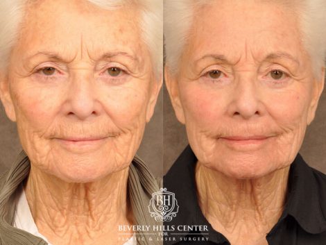 Beverly Hills Center Female Patient Before and After Profound RF, CO2 Laser, IPL and PRP Treatment