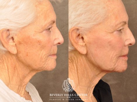Beverly Hills Center Female Patient Before and After Profound RF, CO2 Laser, IPL and PRP Treatment