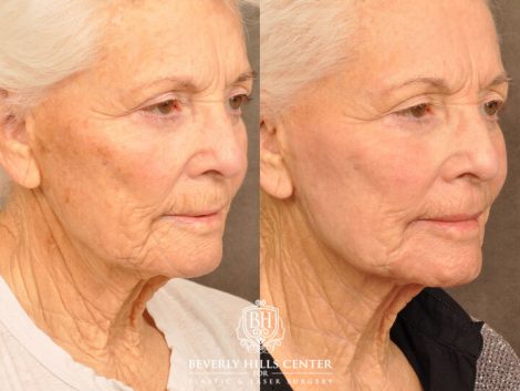 Beverly Hills Center Female Patient Before and After Profound RF, CO2 Laser, IPL and PRP Treatment