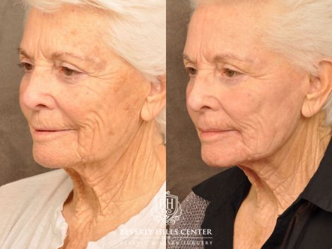Beverly Hills Center Female Patient Before and After Profound RF, CO2 Laser, IPL and PRP Treatment