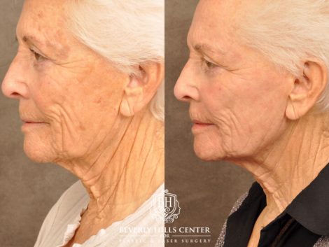 Beverly Hills Center Female Patient Before and After Profound RF, CO2 Laser, IPL and PRP Treatment