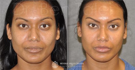 Beverly Hills Center Female Patient Before and After Profound MicroLift with Tri-L Treatment