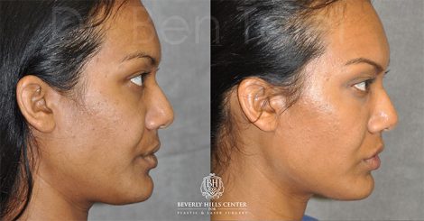Beverly Hills Center Female Patient Before and After Profound MicroLift with Tri-L Treatment