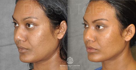 Beverly Hills Center Female Patient Before and After Profound MicroLift with Tri-L Treatment
