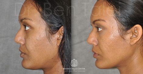Beverly Hills Center Female Patient Before and After Profound MicroLift with Tri-L Treatment
