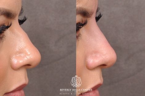 Beverly Hills Center Female Patient Before and After Liquid Rhinoplasty Procedure