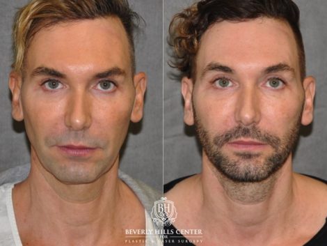 Beverly Hills Center Male Patient Before and After Profound MicroLift Treatment
