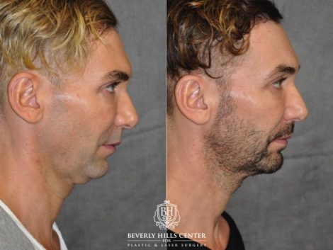 Beverly Hills Center Male Patient Before and After Profound MicroLift Treatment