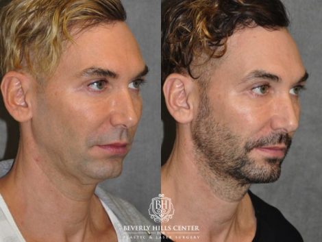 Beverly Hills Center Male Patient Before and After Profound MicroLift Treatment